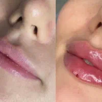 جشنواره تخفیف ژل لب،بوتاکس،فیلرشقیقه توسط پزشک