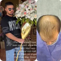 راهنمایی کاشت مو