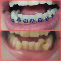 ارتودنسی لبخندی زیبا(فقط تا آخر ماه)|خدمات آرایشگری و زیبایی|مشهد, آزادشهر|دیوار