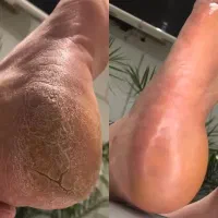 کرم ترک پا