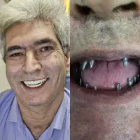 ایمپلنت ۸۵۰۰ و ۱۱،۴۰۰ با ضمانت واقساط|خدمات زیبایی و سلامت|تهران, شهرآرا|دیوار