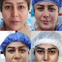 کاشت مو و ابرو شیرازی در سنندج