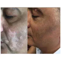 درمان گیاهی بیماری پیسی وپسوریازیس|خدمات آرایشگری و زیبایی|مشهد, حرم مطهر رضوی|دیوار