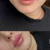 مزو و جوانساز هر سی سی ۱۵۰۰ با تخفیف ۸۰۰