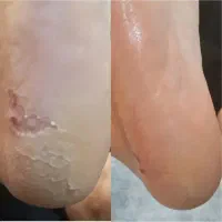 کف سابی تخصصی ترک های عمقی با تغیر در یک جلسه