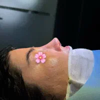 عمل بینی فقط با ۲۵ تومن تا پایان مهر ماه در تهران|خدمات آرایشگری و زیبایی|قم, بکایی|دیوار