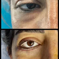 جراحی عمل پلک/بلفاروپلاستی/ساکشن غبغب/سانترال لب|خدمات آرایشگری و زیبایی|کرج, عظیمیه|دیوار