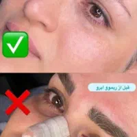 پاک کردن تتو با پیشرفته ترین لیزر کیوسوئیچ|خدمات آرایشگری و زیبایی|اهواز, کوی سعدی|دیوار