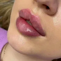 فیلر ژل لب گونه چونه هایفو صورت بوتاکس لیزر بدن