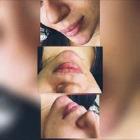 تزریق ژل و بوتاکس|خدمات آرایشگری و زیبایی|بیرجند, |دیوار