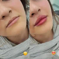 ژل ،بوتاکس،مزوتراپی مو، خال برداری ،لیزر مو|خدمات آرایشگری و زیبایی|اسلام‌شهر, باغ فیض|دیوار