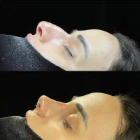 عمل بینی بادستگاه پیزوسرجری وNSK(جشنواره تابستانه)|خدمات آرایشگری و زیبایی|کاشان, میدان کهنه|دیوار