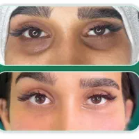 فیلر زیر چشم (رفع گودی زیر چشم)