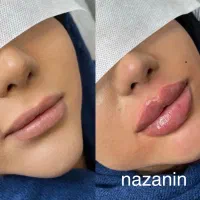 مطب گرگان عدالت ۱۳ بوتاکس ۸۰۰ ژل۱ تومان توسط پزشک|خدمات آرایشگری و زیبایی|گرگان, |دیوار