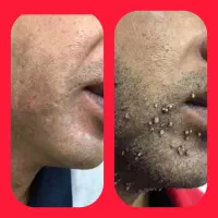 پایان زگیل و تبخال تناسلی با یک روش گیاهی وریشه ای