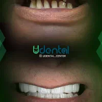 کاشت لبخند / کامپوزیت لمینیت|خدمات آرایشگری و زیبایی|تهران, قبا|دیوار