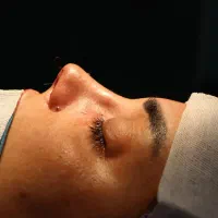 عمل بینی ۲۷ تومن//.لیپو.ابدو