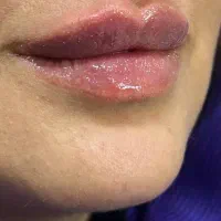 ژل بوتاکس زیبایی بینی لیفت صورت و بدن|خدمات آرایشگری و زیبایی|مشهد, هفت تیر (آب و برق)|دیوار
