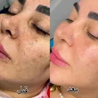 جشنوار یلدا درمان تضمینی کک ومک/لک/خال/فقط در1جلسه|خدمات آرایشگری و زیبایی|اصفهان, باغ زیار|دیوار