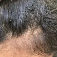 درمان شپش با مواد کاملا گیاهی