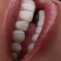 داندانپزشکی کامپوزیت لبه شیشه ای آفر ویژه عید