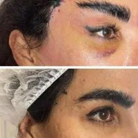 لیپو ابدو کاشت مو ابرو تزریق چربی ژل بوتاکس بلفارو|خدمات آرایشگری و زیبایی|اهواز, نادری|دیوار