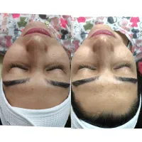 پاکسازی صورت|خدمات آرایشگری و زیبایی|زنجان, |دیوار