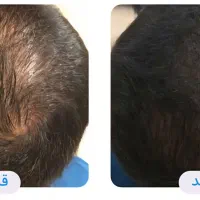 پی آر پی و مزوتراپی مو و ابرو|خدمات آرایشگری و زیبایی|اردبیل, |دیوار