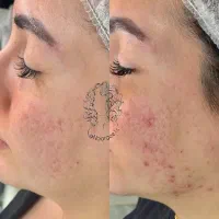 رفع تیرگی بدن، لک و جای جوش و جوانسازی طبیعی