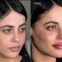 جشنواره ی ۵۰ درصد آف ویژه ی ژل بوتاکس توسط پزشک|خدمات آرایشگری و زیبایی|کرمانشاه, |دیوار