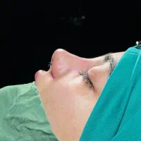 جراحی زیبایی بینی رینوپلاستی اصفهان توسط متخصص ent|خدمات زیبایی و سلامت|اصفهان, عباسآباد|دیوار