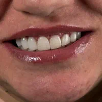 اصلاح لبخند بدون آسیب مشاوره رایگان|خدمات آرایشگری و زیبایی|شیراز, نشاط|دیوار