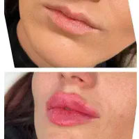 تزریق ژل و بوتاکس تخفیف عیدانه ۴۹۹