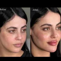 بوتاکس وفیلر صورت و بدن|خدمات آرایشگری و زیبایی|بیرجند, |دیوار