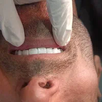 دندانپزشکی کامپوزیت ونیر فقط 9میلیون  اقساطی|خدمات آرایشگری و زیبایی|ارومیه, |دیوار