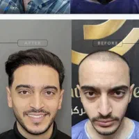 کاشت مو.ابرو.ریش . تخصصی با شرایط ویژه