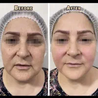 اولین.مرکز(هایفوترکیب با4دستگاه)22و12بعدآراف.کارنت|خدمات زیبایی و سلامت|اهواز, زیتون کارمندی|دیوار