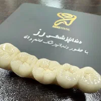 روکش ایمپلنت دندان مصنوعی