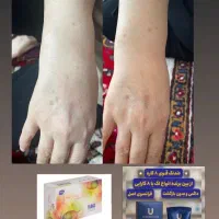 کرم ضد لک و صابون لایه بردار