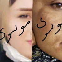 روشن کننده وضدلک درمانی بدون بازگشت تضمینی|آرایشی، بهداشتی، درمانی|یاسوج, |دیوار