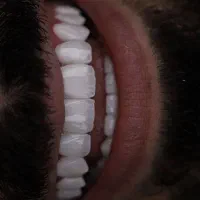 دندانپزشکی وایمپلنت با شرایط اقساطی