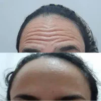 اموزش انواع مزو‌مو‌و صورت و بوتاکس ایرانی و خارجی