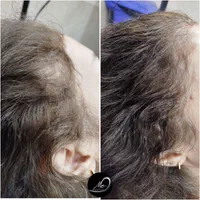 میکرواسکالپ سر|خدمات آرایشگری و زیبایی|محلات, |دیوار