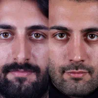 جراحی بینی در مجهز ترین کلینیک بدون تامپون|خدمات آرایشگری و زیبایی|تهران, شهر زیبا|دیوار