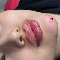 تخفیف تزریق ژل و بوتاکس