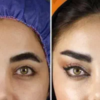 جشنواره تخفیف جراحی زیبایی شقیقه،بلفارو،دایرکت|خدمات آرایشگری و زیبایی|پرند, فاز ۲|دیوار