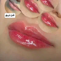 جشنواره تخفیف پی آر پی و ژل و بوتاکس