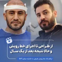 کاشت مو با تراکم بسیار بالا در یک روز