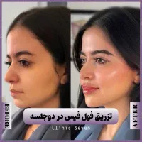 تخفیفات ۵۰% دکتر بوتاکس مزو فیلر ژل لب روسی|خدمات آرایشگری و زیبایی|مشهد, هنرستان|دیوار