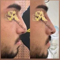 اصلاح فرم بینی بدون جراحی توسط پزشک